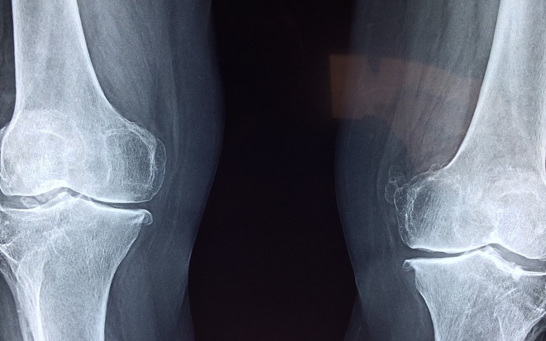 Preventing and Improving Knee Pain